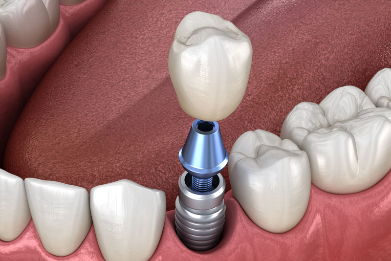 Revitalizing Your Smile: The Comprehensive Guide to Implant Dentistry in Webster, TX