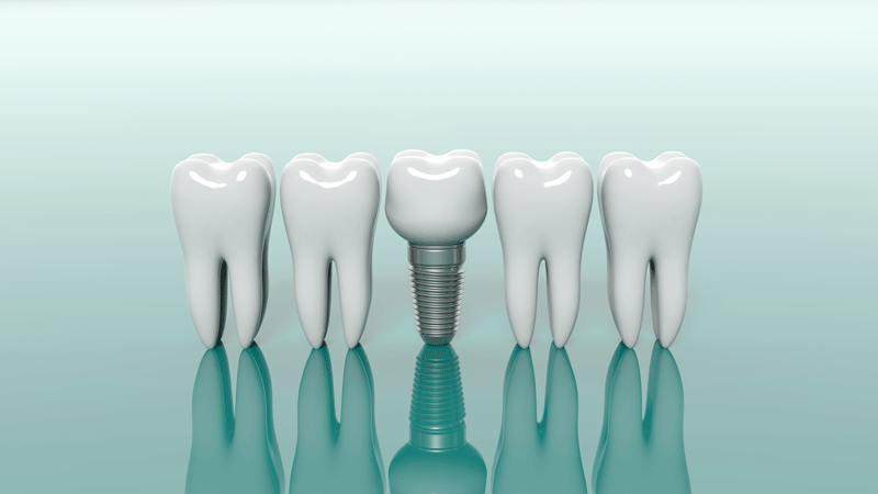 Should Sedation Dentistry Be Used For Full Mouth Dental Implant Procedures?