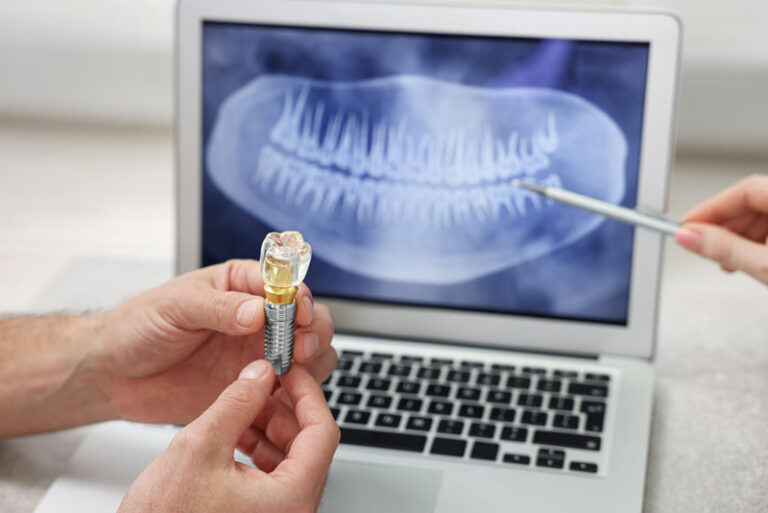 Longevity of Dental Implants Causes and Fixes for Damages Renew
