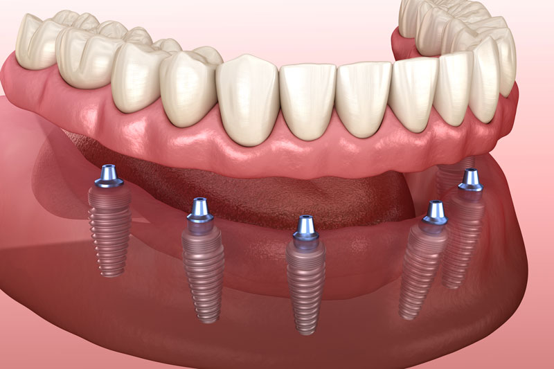 Unveiling the Benefits of All on 4 Dental Implants in Webster, TX