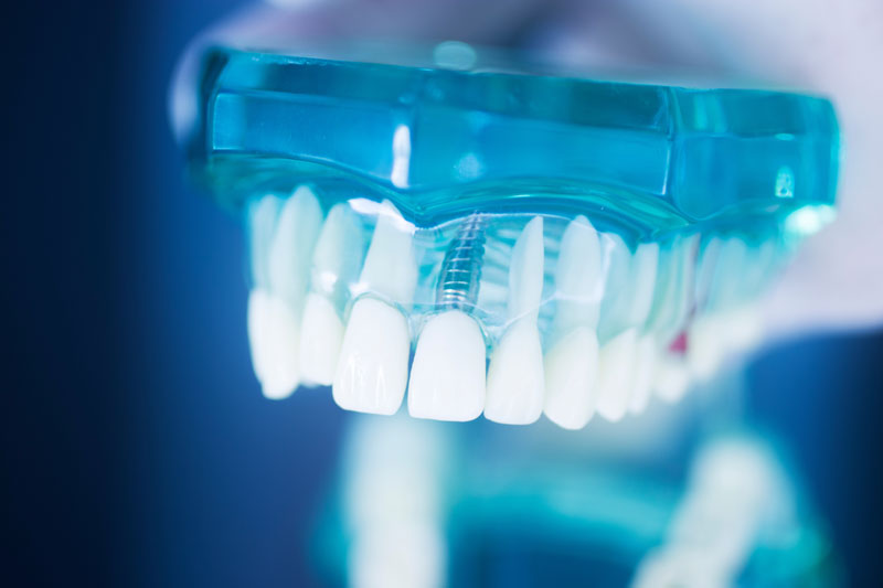 Discover the Promising World of Teeth Implants