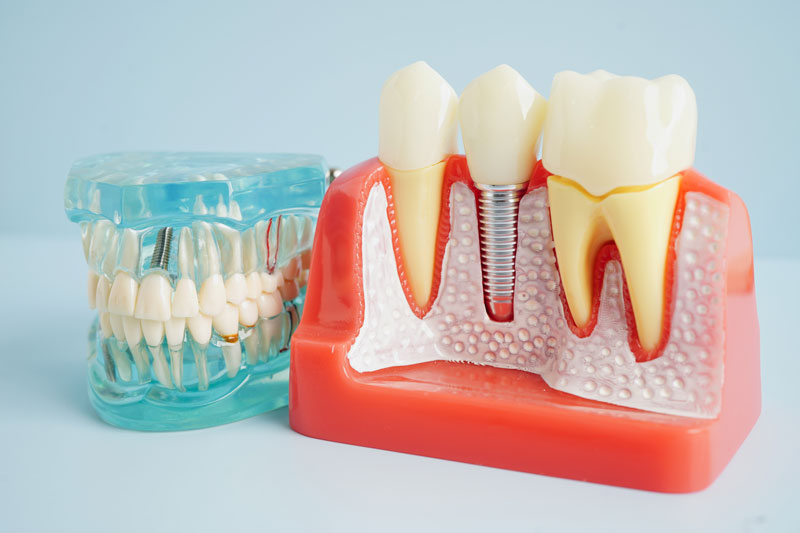 Unveiling the Mystery of Implant Dentistry in Webster, TX